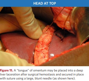 A “tongue” of omentum may be placed into a deep liver laceration