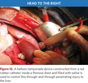 A balloon tamponade device