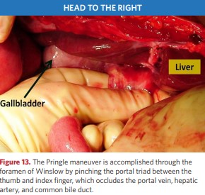 The Pringle maneuver