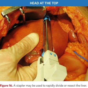 A stapler may be used to rapidly divide or resect the liver