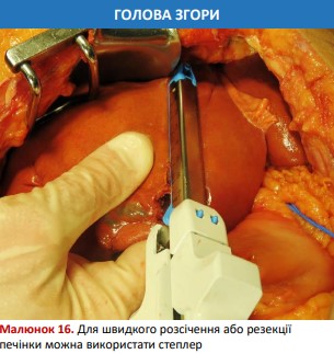 Резекція печінки за допомогою степлера