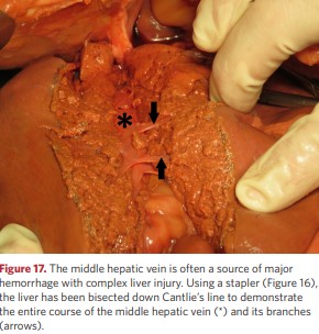 The middle hepatic vein