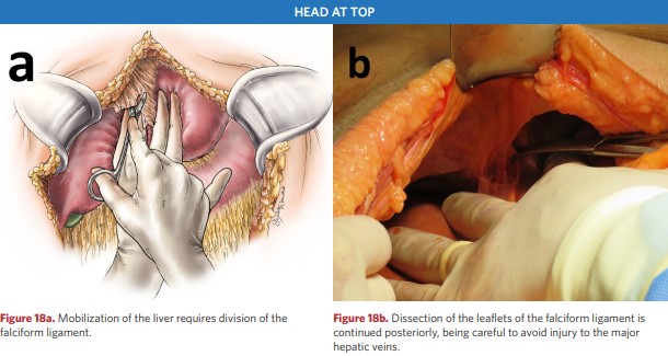 Dissection of the leaflets