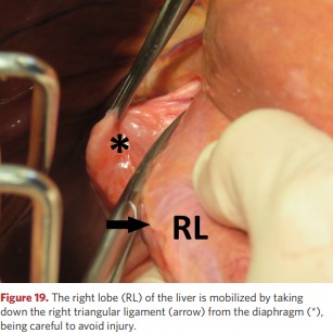 The right lobe (RL) of the liver