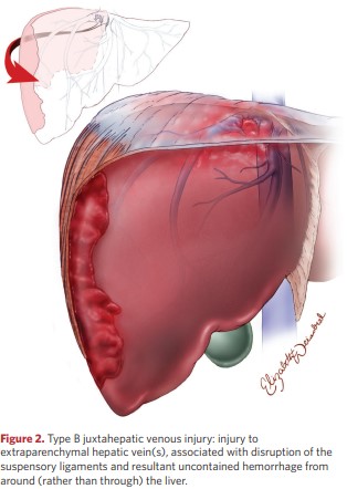 Type B juxtahepatic venous injury