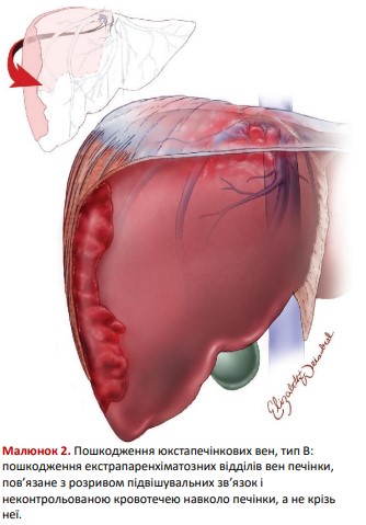 Пошкодження юкстапечінкових вен, тип В