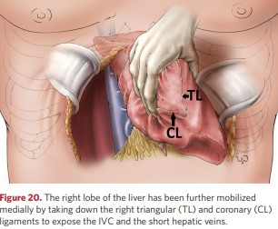 The right lobe of the liver has been further