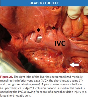 The right lobe of the liver has been mobilized medially