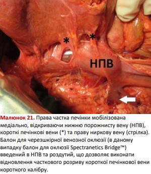 Права частка печінки мобілізована медіально