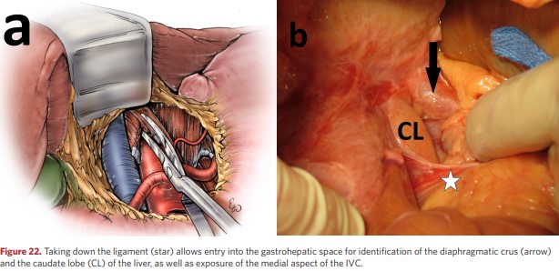 Gastrohepatic space 