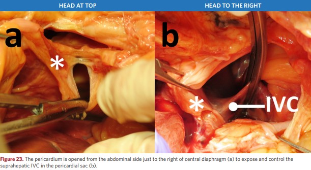 The pericardium is opened from the abdominal side