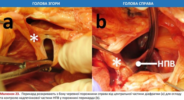 Перикард розкривають з боку черевної порожнини