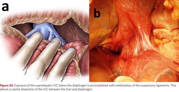 Exposure of the suprahepatic IVC below the diaphragm