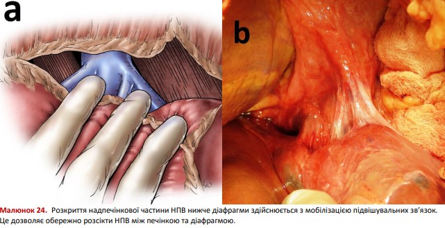 Розкриття надпечінкової частини НПВ нижче діафрагми
