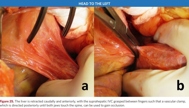 The liver is retracted caudally and anteriorly