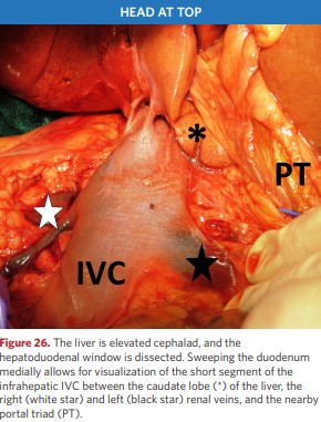 The liver is elevated cephalad, and the hepatoduodenal window is dissected