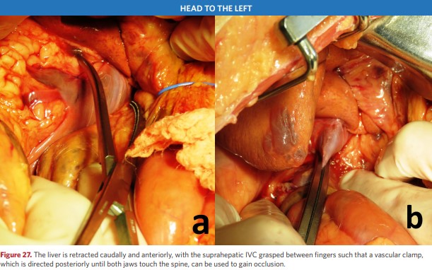 The liver is retracted caudally and anteriorly