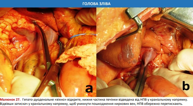 Гепато-дуоденальне «вікно» відкрите