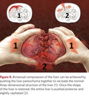 Bimanual compression of the liver