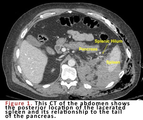 This CT of the abdomen shows the posterior location of the lacerated spleen and its relationship to the tail of the pancreas