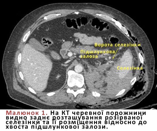 На КТ черевної порожнини видно заднє розташування розірваної селезінки та її розміщення відносно до хвоста підшлункової залози