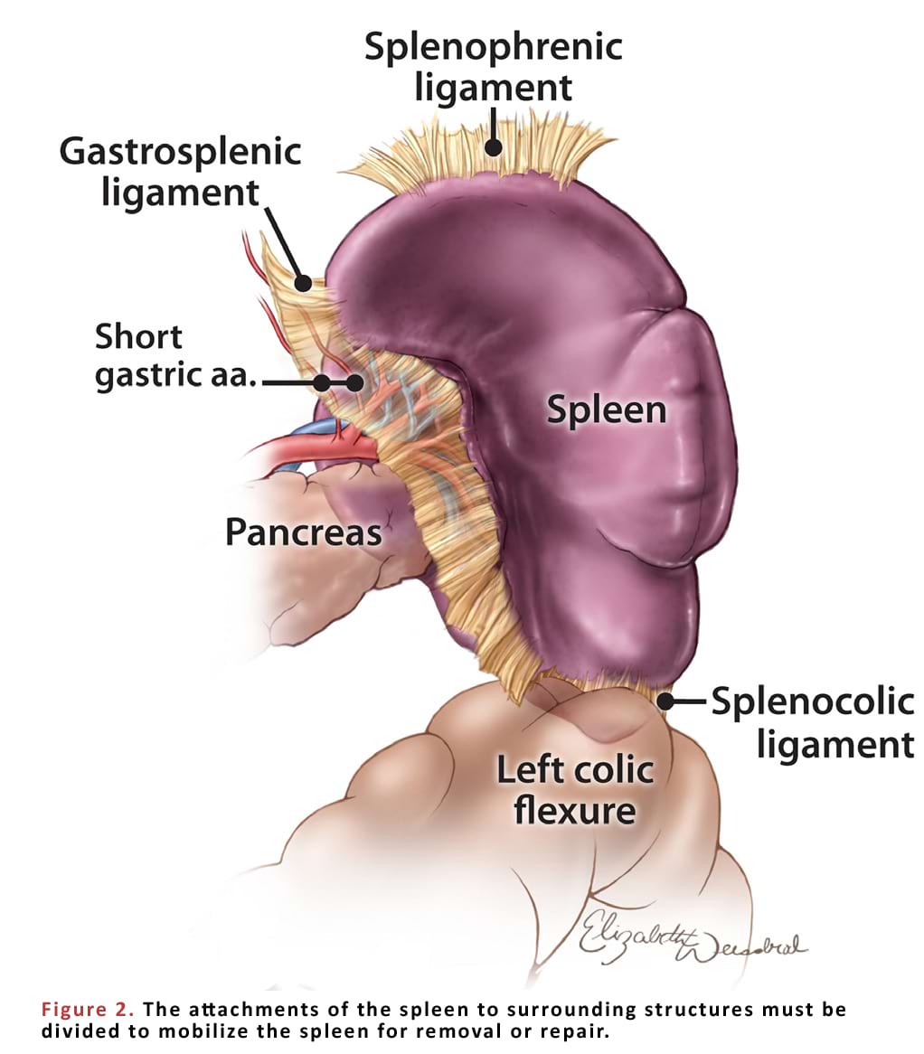 The attachments of the spleen to surrounding structures must be divided to mobilize the spleen for removal or repair