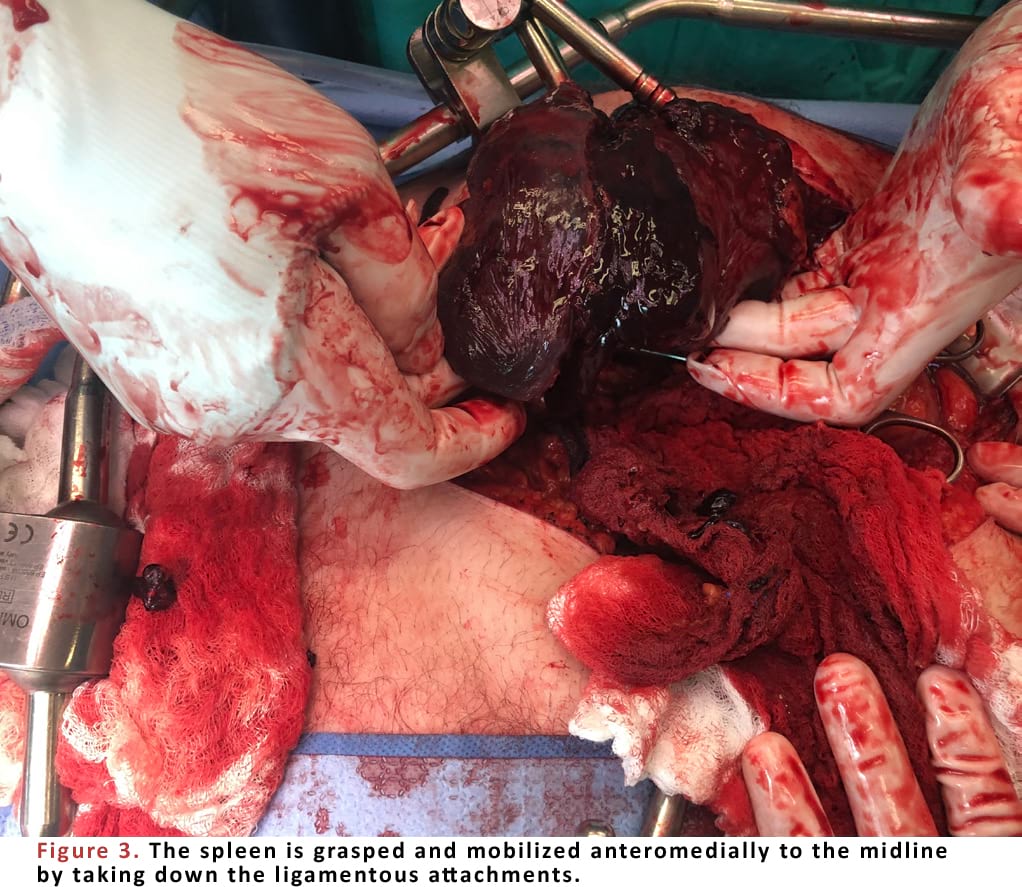 The spleen is grasped and mobilized anteromedially to the midline by taking down the ligamentous attachments