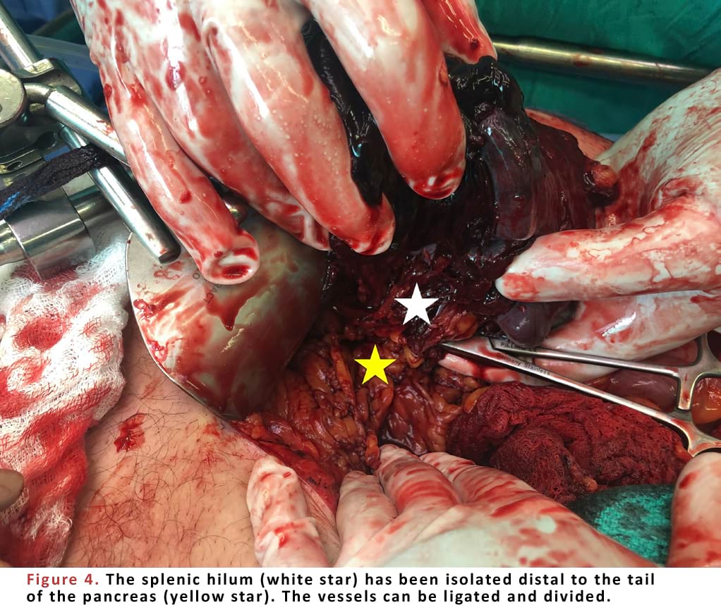 The splenic hilum has been isolated distal to the tail of the pancreas