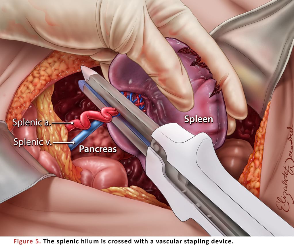 The splenic hilum is crossed with a vascular stapling device