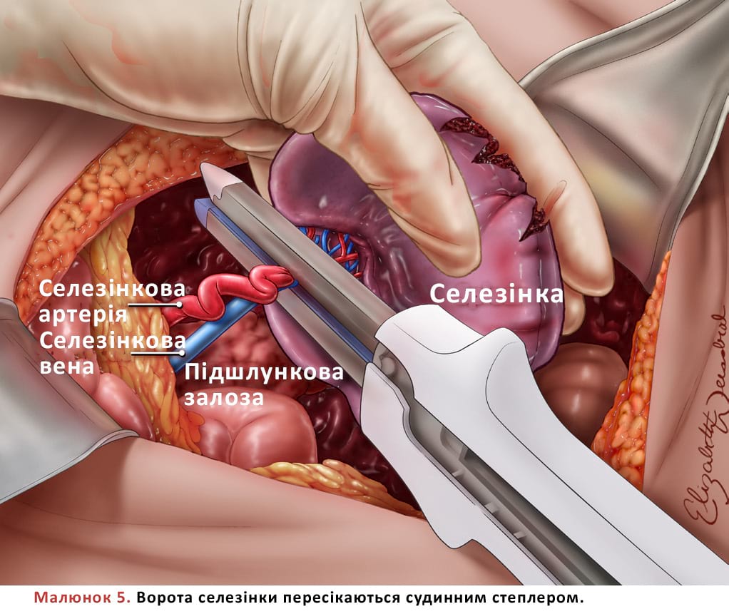 Ворота селезінки пересікаються судинним степлером