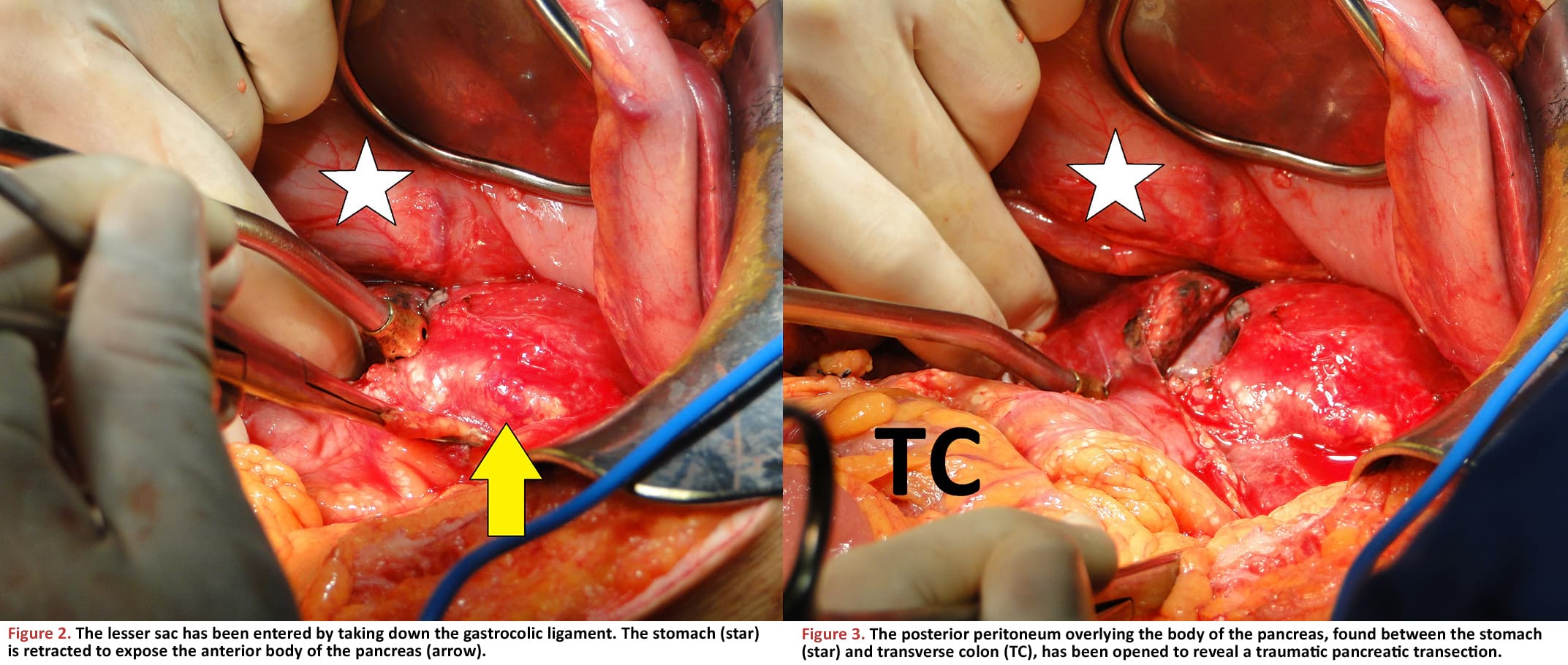 The lesser sac has been entered by taking down the gastrocolic ligament