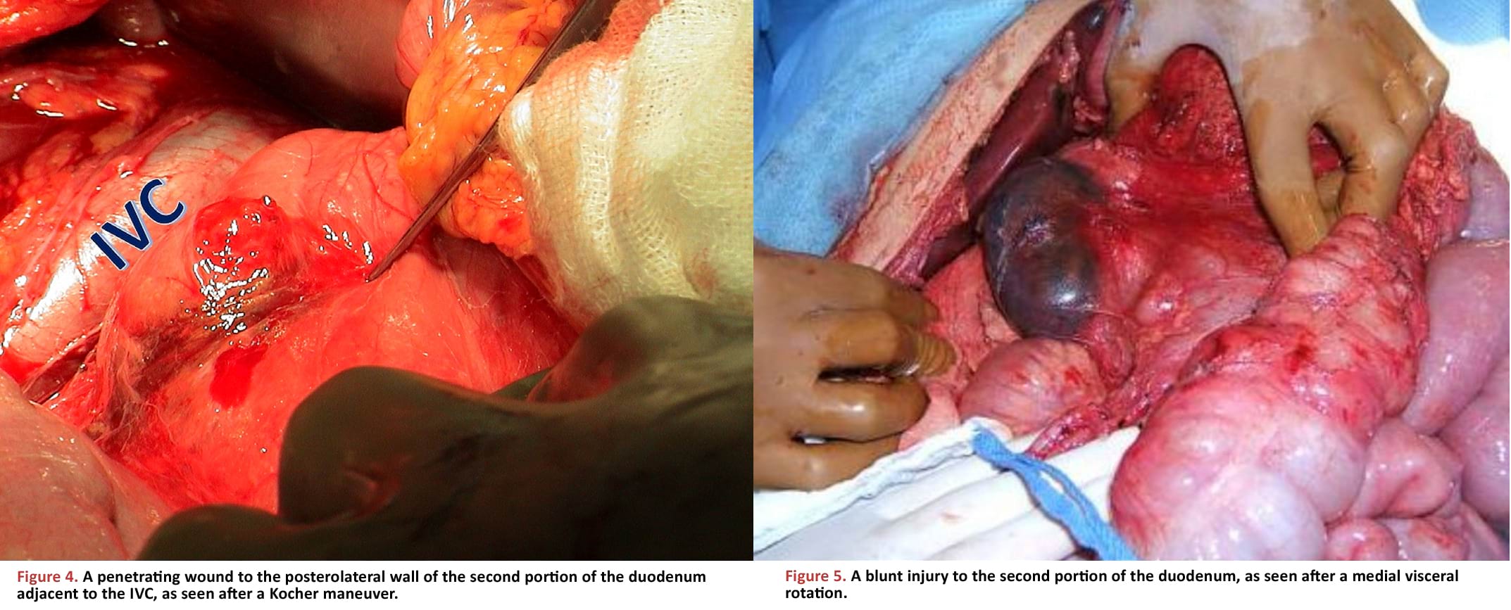 A penetrating wound to the posterolateral wall of the second portion of the duodenum adjacent to the IVC, as seen after a Kocher maneuver