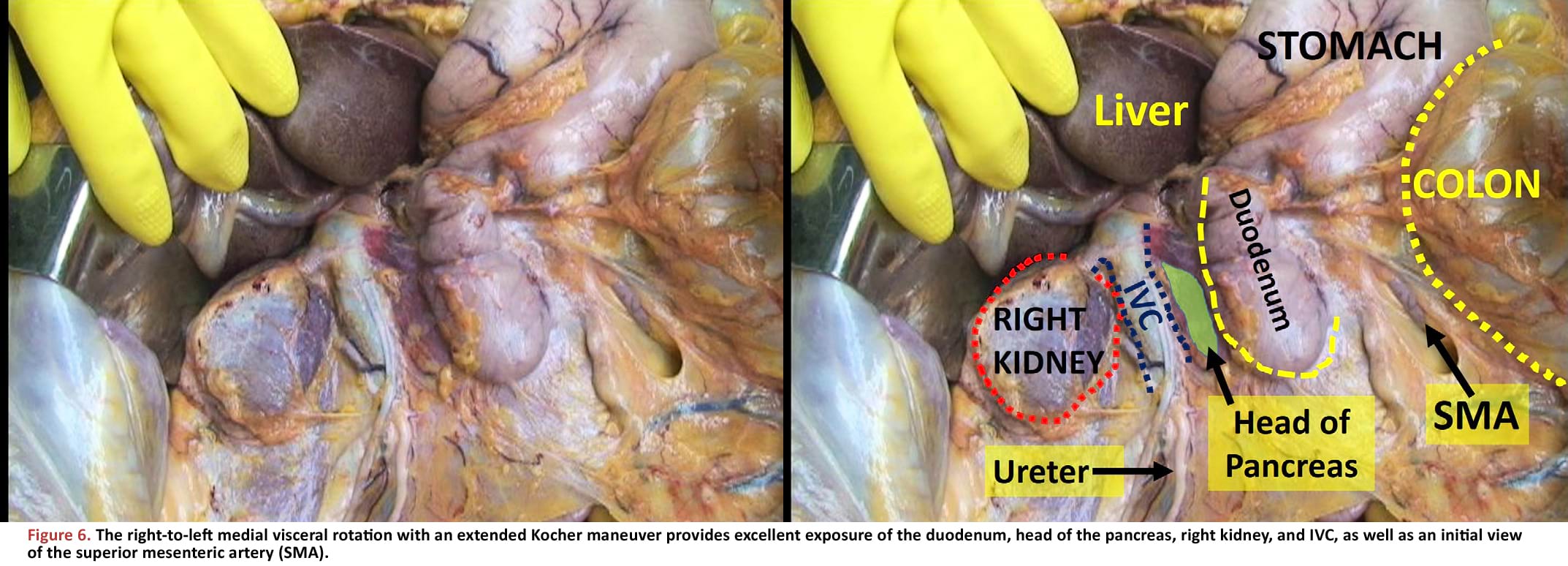 The right-to-left medial visceral rotation with an extended Kocher maneuver provides excellent exposure of the duodenum, head of the pancreas, right kidney, and IVC, as well as an initial view of the superior mesenteric artery