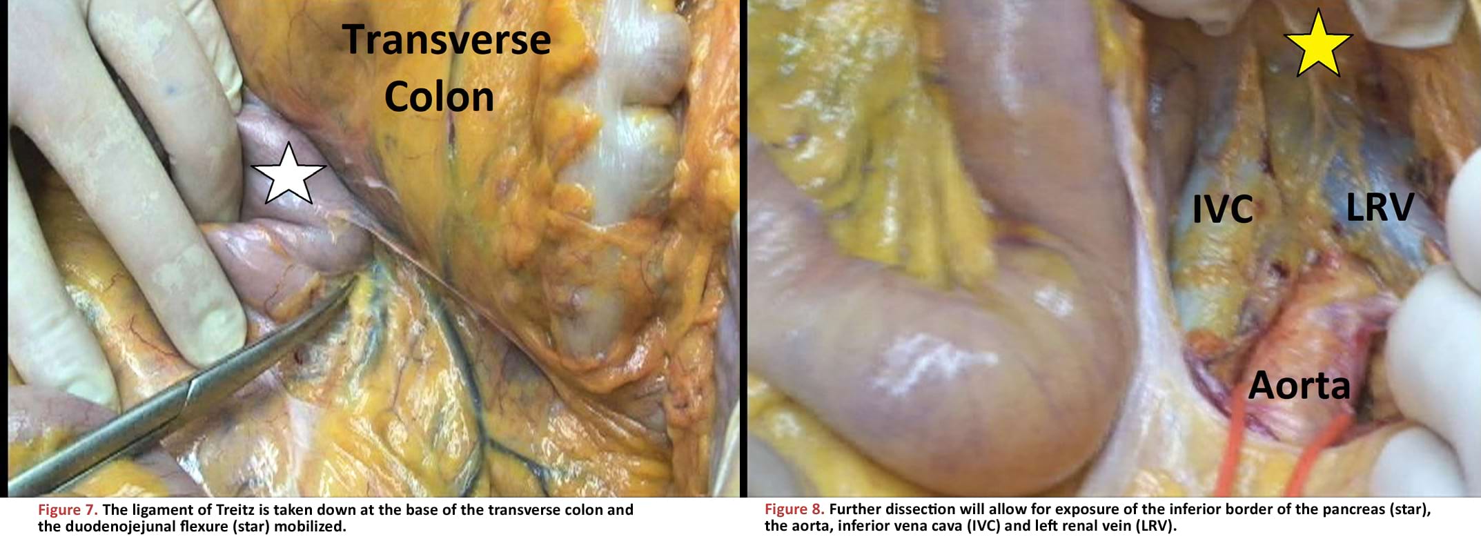 The ligament of Treitz is taken down at the base of the transverse colon and the duodenojejunal flexure mobilized