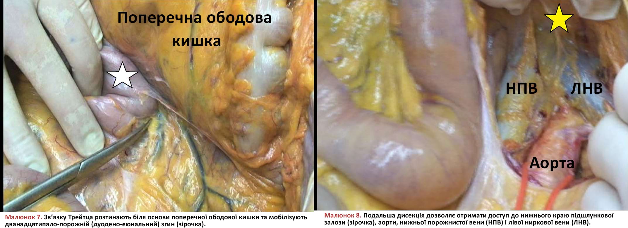 Зв’язку Трейтца розтинають біля основи поперечної ободової кишки та мобілізують дванадцятипало-порожній (дуодено-єюнальний) згин