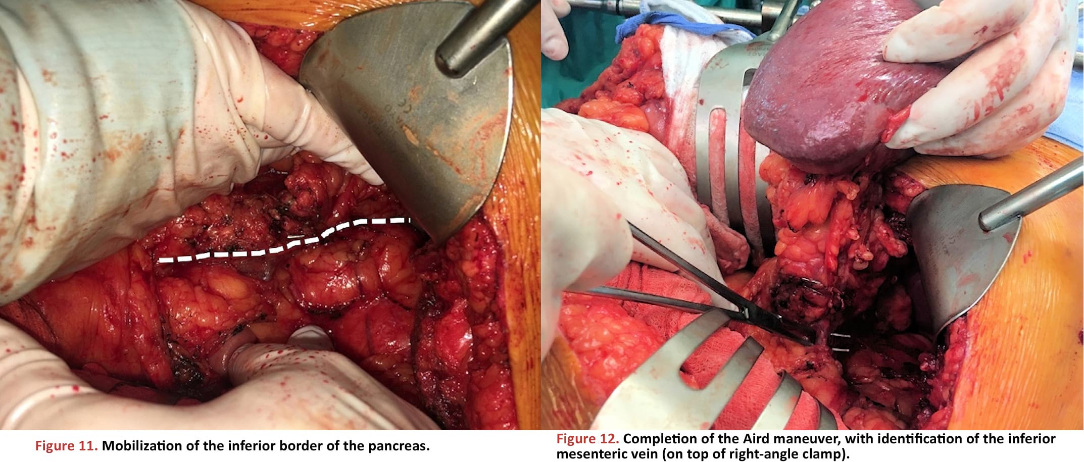 Mobilization of the inferior border of the pancreas