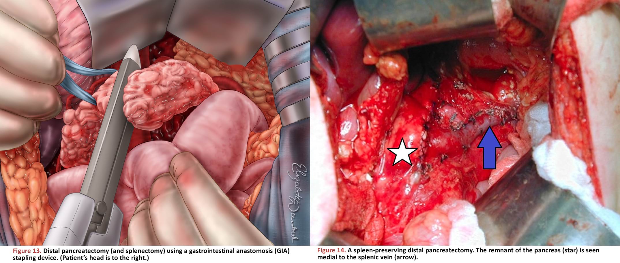 Distal pancreatectomy