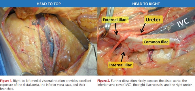 Exposure of the distal aorta