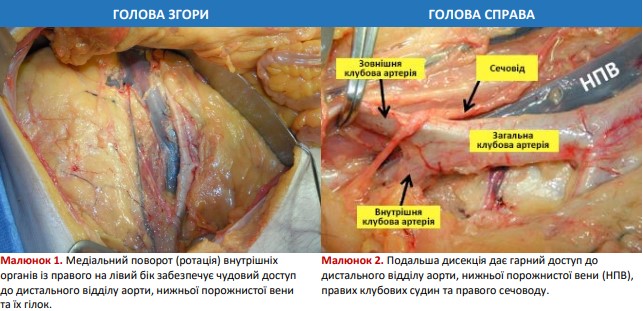 Доступ до дистального відділу аорти