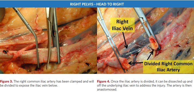 The right common iliac artery has been clamped