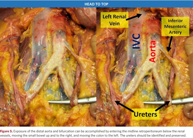 Exposure of the distal aorta and bifurcation