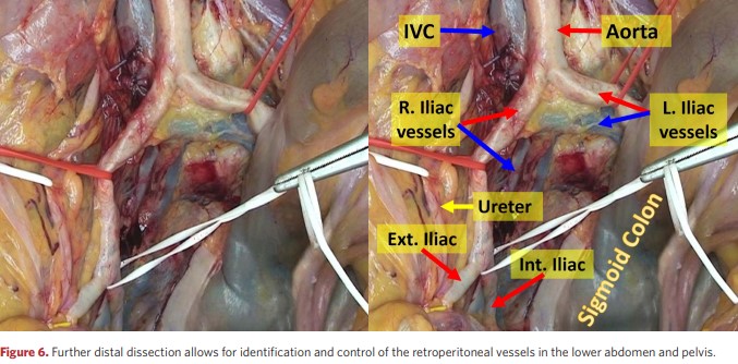 Further distal dissection