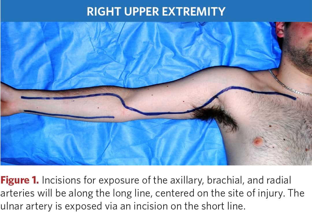 Incision line for exposure to axillary, brachial and radial arteries