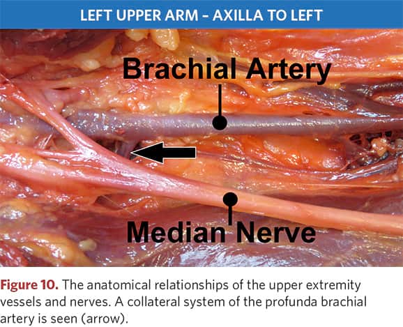 Anatomical relationship of vessels and nerves of the upper limb