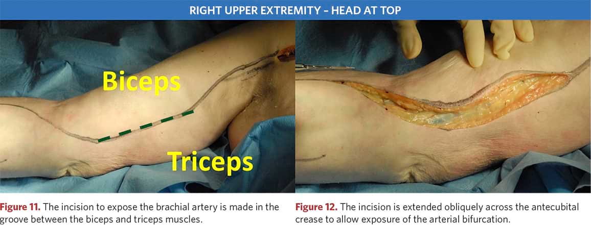 Subcutaneous tissue incision to access the pectoralis major muscle