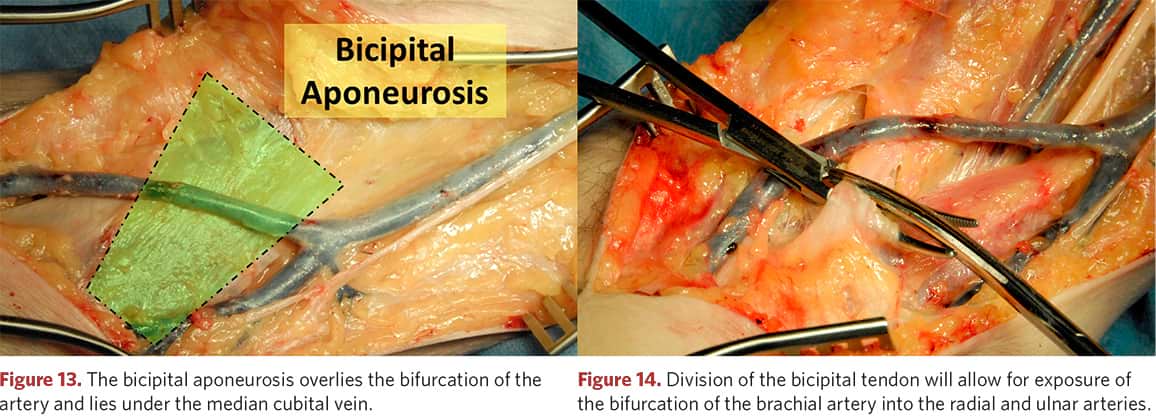 Dissection of the biceps brachii tendon