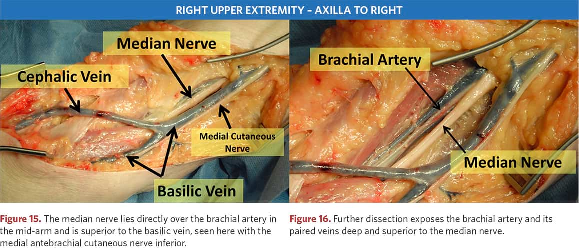 Surgical access to the brachial artery