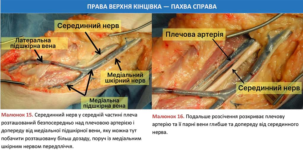 Хірургічний доступ до плечової артерії