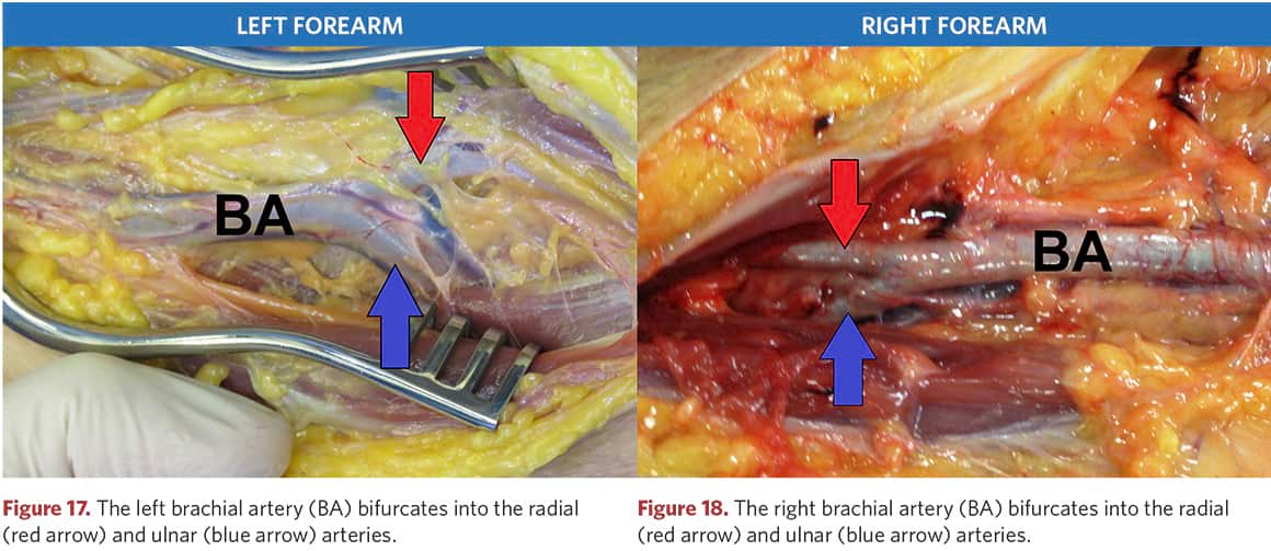 Left and right brachial arteries