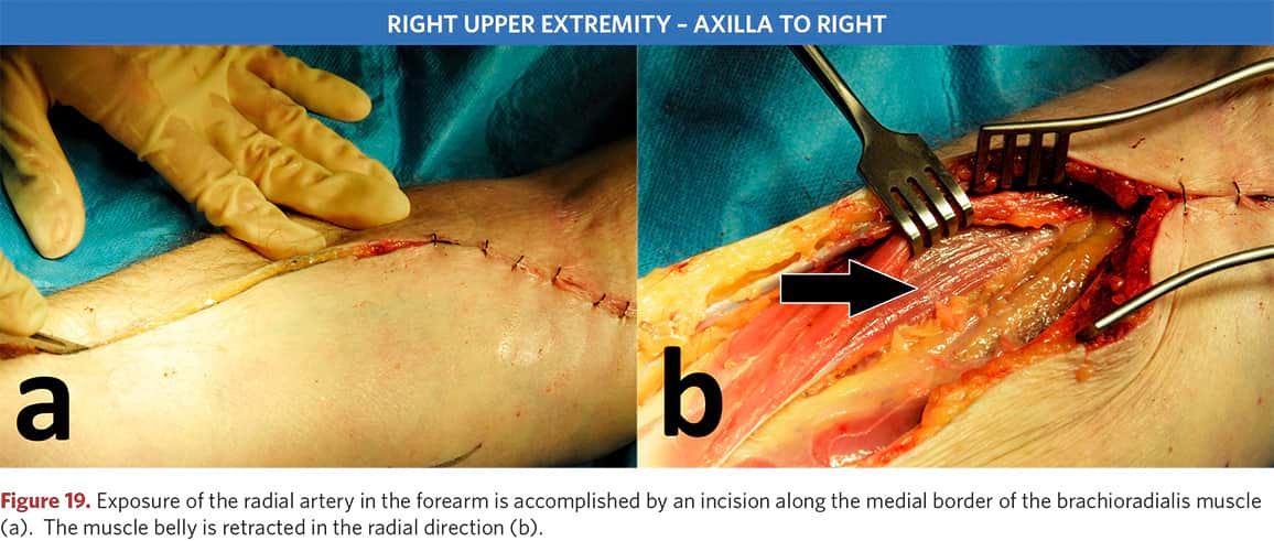 Surgical access to the radial artery